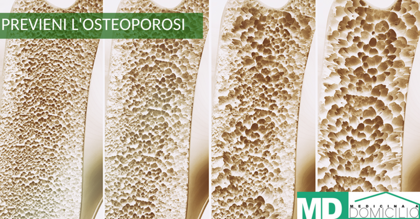 Osteoporosi: Cause, sintomi e Diagnosi