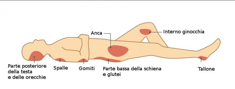 Piaghe da decubito, la lesione comune delle persone anziane o allettate