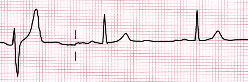 ECG a domicilio: l’elettrocardiogramma a casa tua