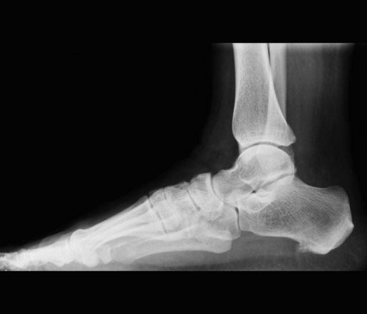 Radiografia domiciliare per distorsione alla caviglia