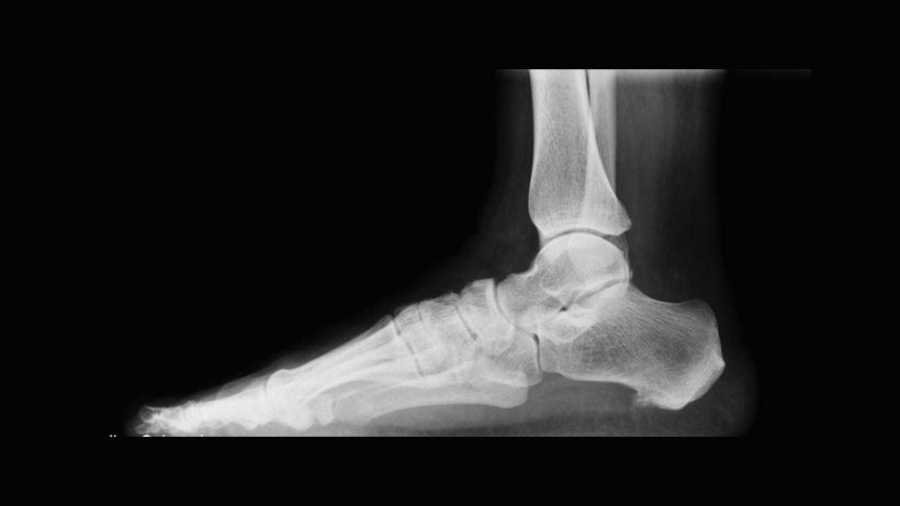 Radiografia domiciliare per distorsione alla caviglia